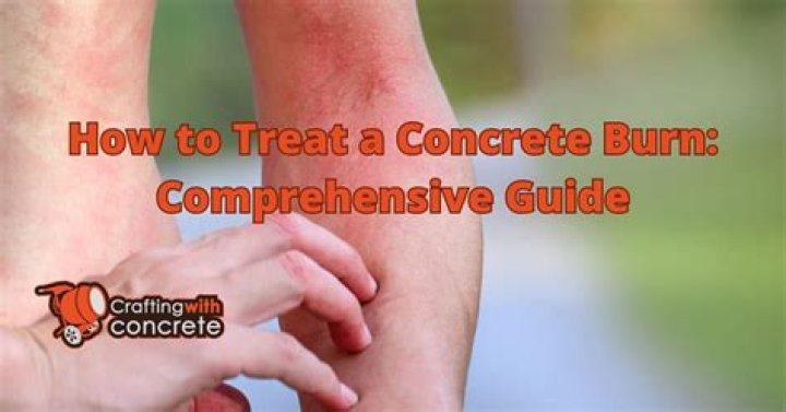 How do you treat lime burns in concrete?